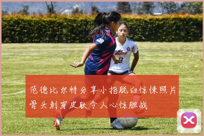 范德比尔特分享小指脱臼惊悚照片骨头刺穿皮肤令人心惊胆战